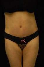 Abdominoplasty