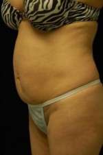 Abdominoplasty