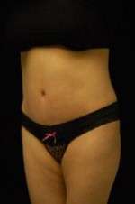 Abdominoplasty