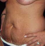 Abdominoplasty