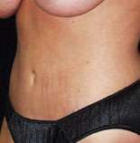 Abdominoplasty