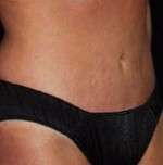 Abdominoplasty