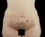 Abdominoplasty