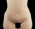 Abdominoplasty