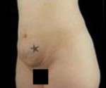 Abdominoplasty