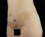 Abdominoplasty