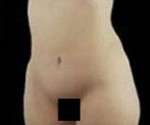 Abdominoplasty