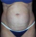 Abdominoplasty