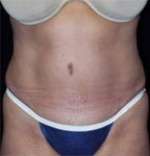 Abdominoplasty