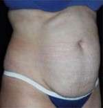 Abdominoplasty