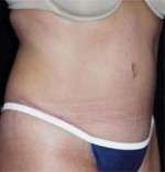 Abdominoplasty