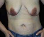 Abdominoplasty