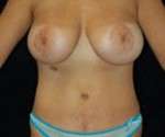 Abdominoplasty