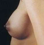 Breast Round, Saline