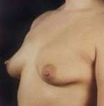 Breast Round, Saline