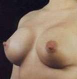 Breast Round, Saline