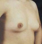 Breast Round, Saline