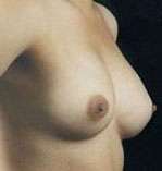 Breast Round, Saline