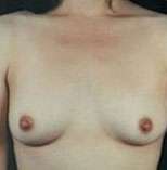 Breast Round, Saline