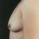 Breast Round, Saline