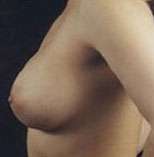 Breast Round, Saline