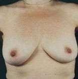 Breast Round, Saline