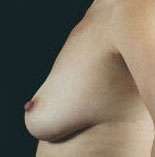 Breast Round, Saline