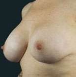 Breast Round, Saline