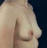 Breast Round, Saline