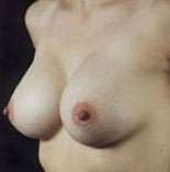 Breast Round, Saline