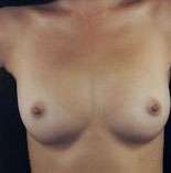 Breast Round, Saline