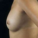 Breast Round, Saline