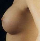 Breast Round, Saline