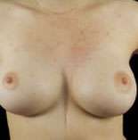 Breast Round, Saline