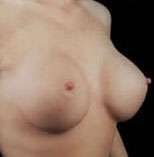 Breast Round, Saline