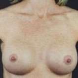 Breast Round, Saline