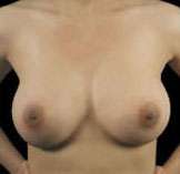 Breast Round, Saline