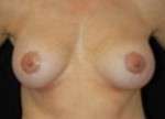 Breast Augmentation, Gel