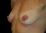 Breast Augmentation, Gel