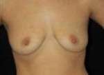 Breast Augmentation, Gel