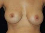 Breast Augmentation, Gel