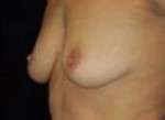 Breast Augmentation, Gel
