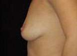 Breast Augmentation, Gel