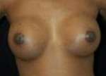 Breast Augmentation, Gel