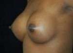 Breast Augmentation, Gel