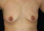 Breast Augmentation, Gel