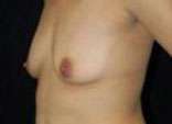 Breast Augmentation, Gel