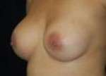 Breast Augmentation, Gel