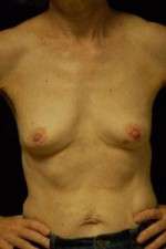 Breast Augmentation, Gel