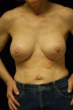 Breast Augmentation, Gel